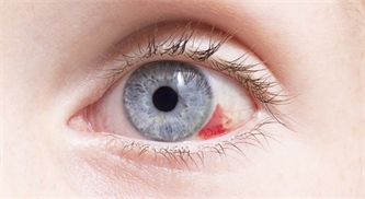 What a Broken Blood Vessel Means for Your Eye