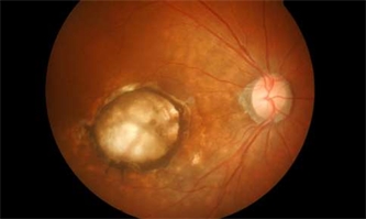 Laser Therapy for Age-Related Macular Degeneration