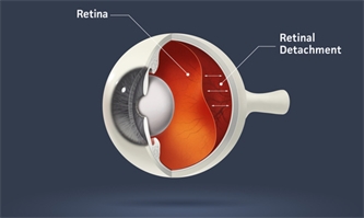 Symptoms of Retinal Detachment