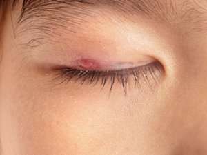 Blepharitis