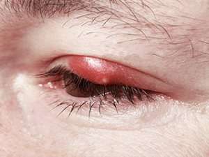 Chalazion