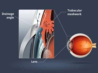 Glaucoma