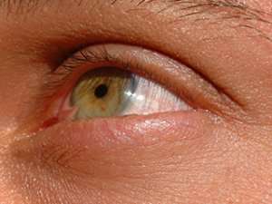 Pinguecula and Pterygium (Surfer's Eye)