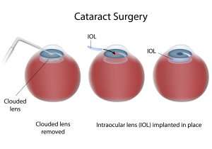 Intraocular Lenses