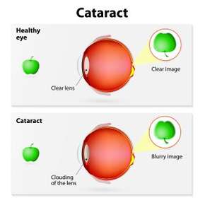 Cataract Surgery