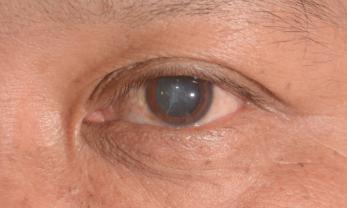 Have You Heard These Cataract Myths?