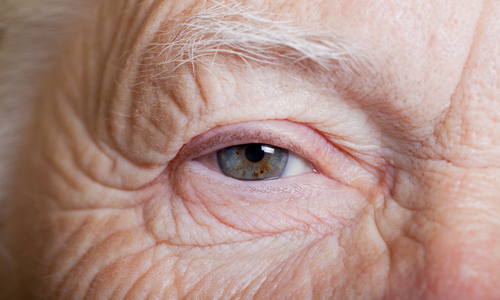 Common Age-Related Vision Problems